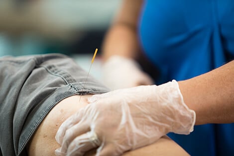 A dry needle sticking out of a man's leg.